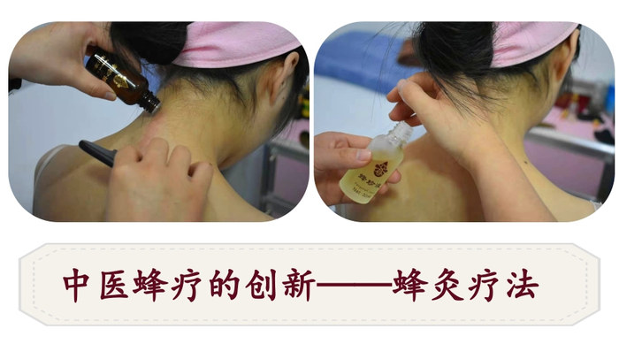蜂灸疗法1 (1).jpg